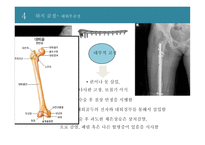 신체 부위별 골절의 치료와 간호 -13