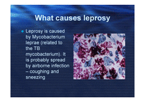 LEPROSY (hansen’s disease) -3