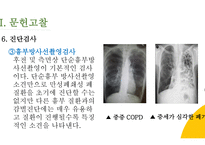 COPD(만성폐쇄성폐질환) 간호과정 PPT-13