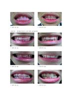 치약의 종류에 따른 치아 살균 효과 및 pH측정 -14