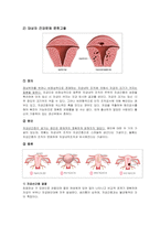 여성건강간호학실습 자궁근종 케이스 [간호진단 및 간호과정 3개]-4