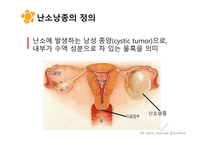 여성실습 난소낭종 케이스 (PPT 자료)-3