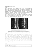 [병태생리] 척추관 협착증, 마미총 증후군-2