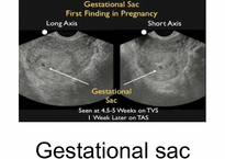 [PBL] Pregnancy ultrasound(임신 초음파)-15
