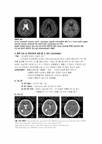 [의학실습]동정맥기형(AVM)-3