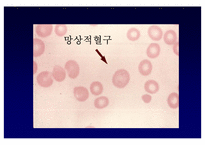[임상화학] 혈액질환 환자에서의 빈혈의 종류와 원인-19