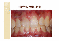 [임상실습] 치주 질환을 유발하는 치면세균막과 치석의 형성 기전 및 치석제거술-14