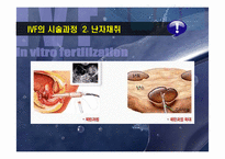 [발생공학] IVF(In vitro fertilization) 기술적 진보와 윤리-7