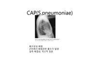 [감염학] CAP의 흉부방사선소견-10