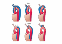 [의학] 대동맥 질환 PBL-14
