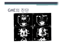 육아종성수막뇌염 Granulomatous meningoencephalitis(GME)-19