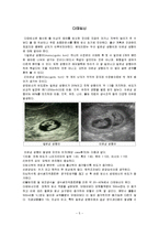 자궁조기수축(다태임신, 시험관아기)-5