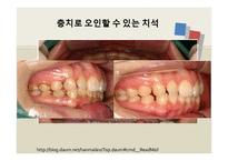 치석제거술과 치근활택술 연구-11