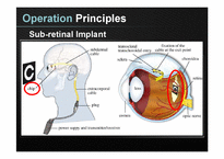 [광소재연구] Retinal Prosthesis-11