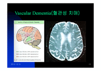 [뇌손상] 치매[dementia]에 관해서-13