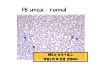 잇몸출혈(chronic gum bleeding) 환자 PBL-17
