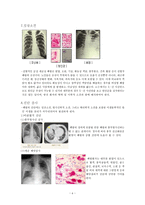 폐렴 대상자 간호-6
