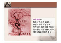 뇌졸중의 이해 레포트-10