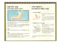 고도비만수술(베리아트릭 수술)-6