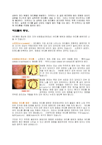 여드름에 관하여 -4