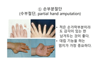 절단 환자와 의지의 관리 -7