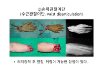 절단 환자와 의지의 관리 -8