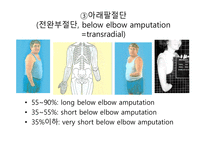 절단 환자와 의지의 관리 -9