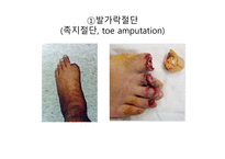 절단 환자와 의지의 관리 -16