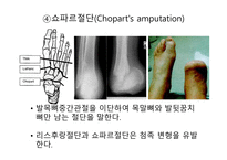 절단 환자와 의지의 관리 -19