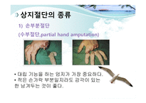 절단 환자와 의지의 관리 -7