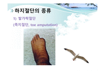 절단 환자와 의지의 관리 -15