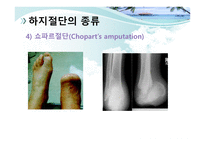 절단 환자와 의지의 관리 -18