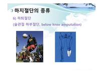 절단 환자와 의지의 관리 -20