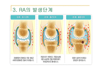 류마티스 관절염 (Rheumatoid Arthritis) -6