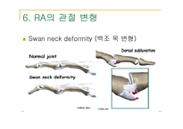 류마티스 관절염 (Rheumatoid Arthritis) -9