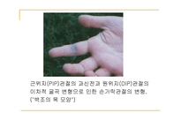류마티스 관절염 (Rheumatoid Arthritis) -10