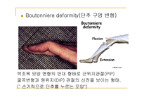 류마티스 관절염 (Rheumatoid Arthritis) -11
