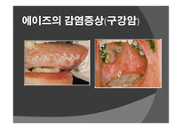 에이즈란, 감염 경로, 감염 증상 -9