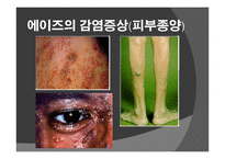 에이즈란, 감염 경로, 감염 증상 -10