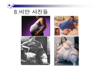 비만의 정의, 원인, 과정, 종류 -12