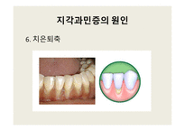 지각과민증 보고서-11