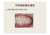 지각과민증 보고서-13