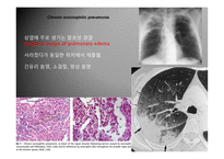 의대 본과 4학년 PK과제 호산구성 폐질환-20