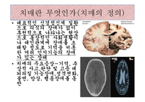 소리없는 죽음 치매 - 치매란 무엇인가 -2