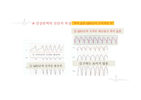 심실에서 발생하는 부정맥-11