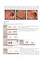 성인간호학실습 케이스스터디 (궤양성 대장염) [간호진단 및 간호과정 3개]-6