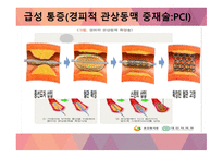심근경색(MI) 간호과정(4개) [PPT 발표자료]-19