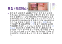 [성의 생물학] 성병의 종류와 원인 및 예방법-7