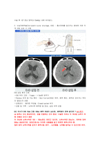 신규간호사도 이해할 수 있게 만든 뇌내출혈 및 두개내압 공부-5