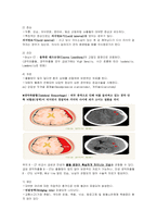신규간호사도 이해할 수 있게 만든 뇌내출혈 및 두개내압 공부-9